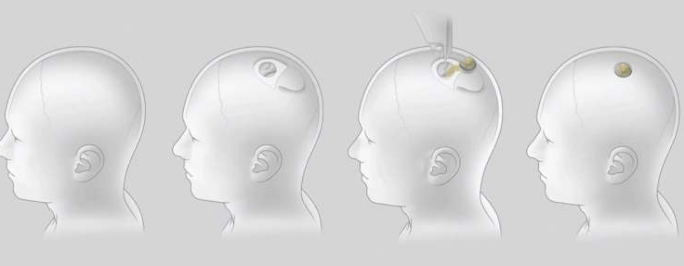 Schéma de Neuralink montrant comment la puce sera implantée dans le cerveau humain.